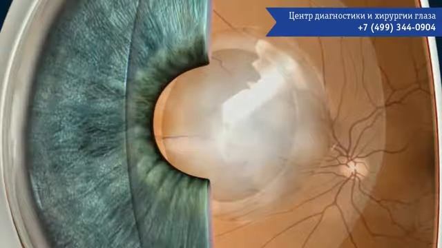 Вторичная катаракта