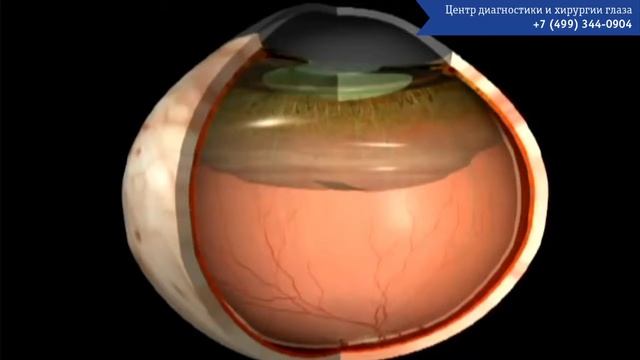 Задняя отслойка стекловидного тела