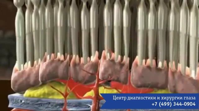 Влажная форма макулярной дегенерации