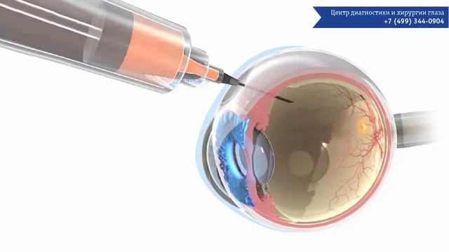 Лечение влажной формы макулодистрофии