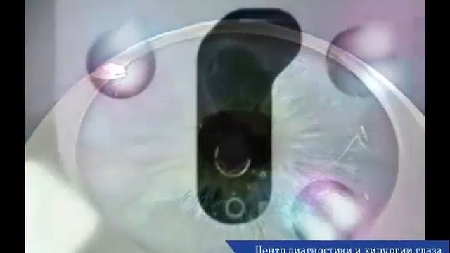 Коррекция астигматизма