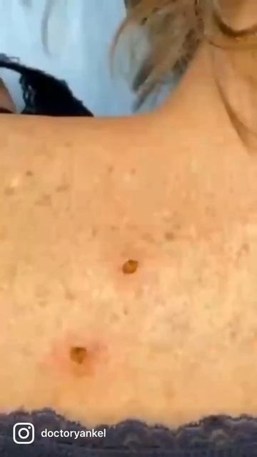 Удаление родинки с помощью лазера