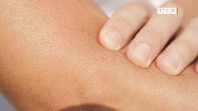 Что делать, если укусила пчела