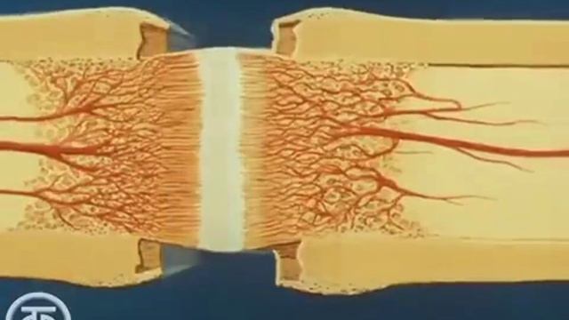 чрескостный остеосинтез по Илизарову