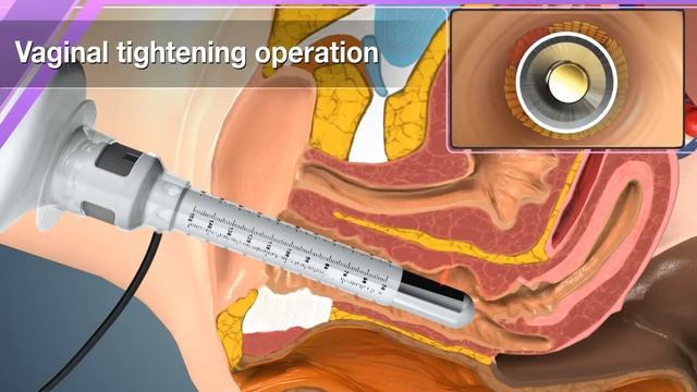 ILOODA Gynolaser Animation