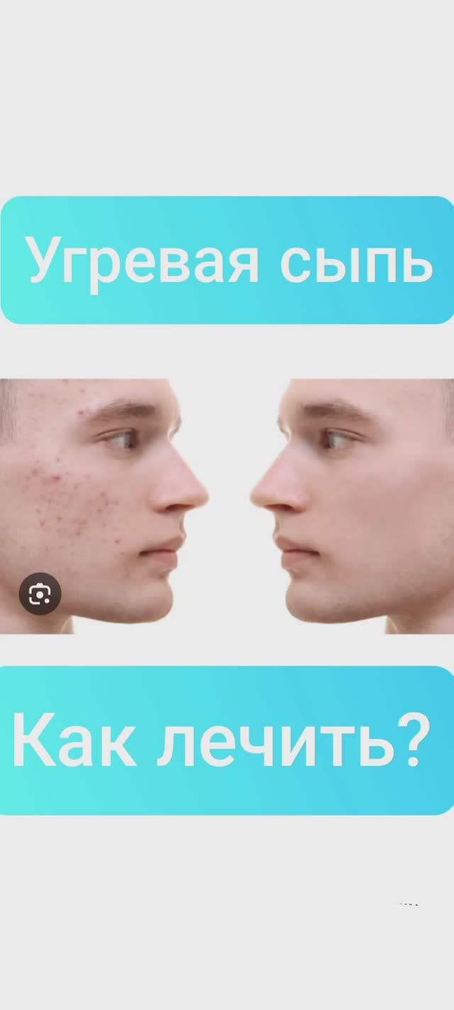 Угревая сыпь. Как лечить?