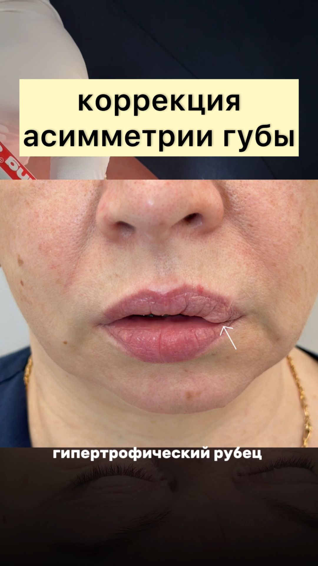 после ушиба у пациентки появился рубец, из-за чего губы выглядели асимметрично