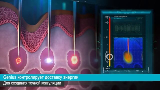 Lutronic Genius Презентация Аппарата