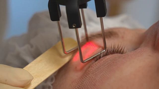 Процедура на аппарате DEKA SmartXide Punto. Клиника профессора Юцковской