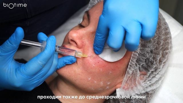 Техника биоревитализации 