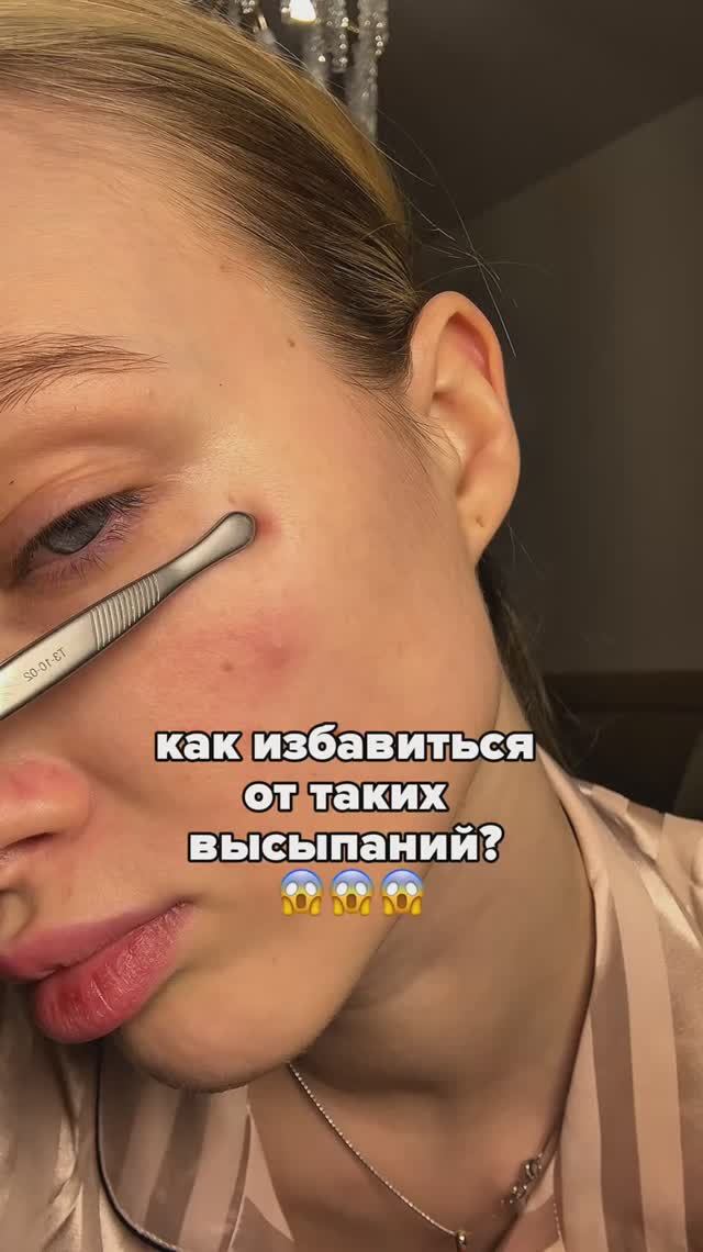 Как избавиться от прыщей?