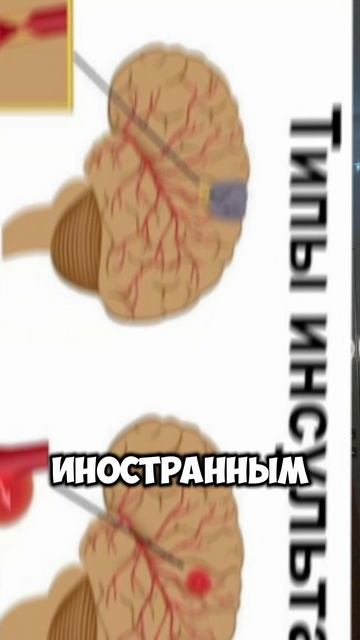 СЕКРЕТ | СИНДРОМ ИНОСТРАННОГО АКЦЕНТА