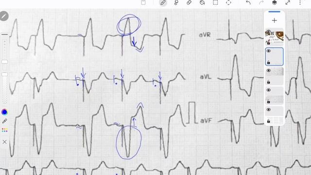 Разбор ЭКГ ПЭКС и ОКС