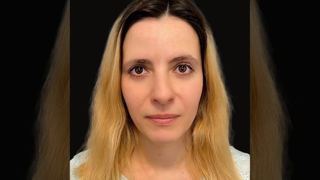 #круговая_блефаропластика: спустя 2 месяца