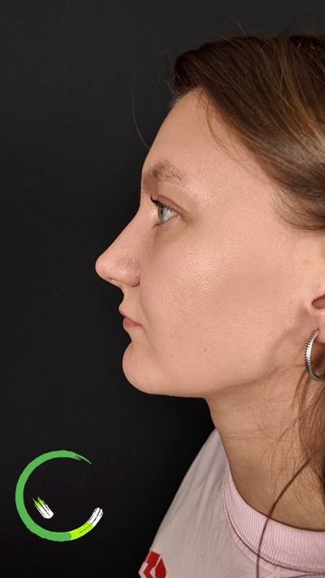 Две недели после гибридной сохраняющей ринопластики.