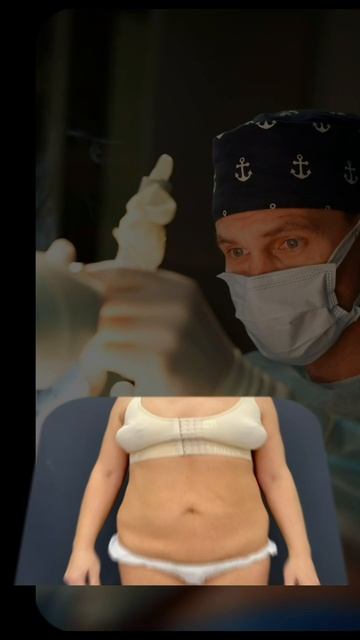 #липоабдоминопластика: спустя 3 месяца