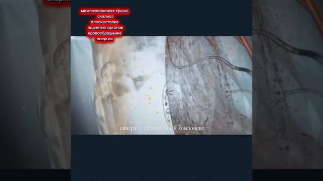 Скалиоз, артрит, артроз, межпозвонковая грыжа, холка, второй подбородок, живот.
Коррекционные гаджет