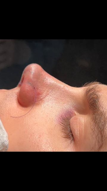 Результат вторичной ринопластики на операционном столе.