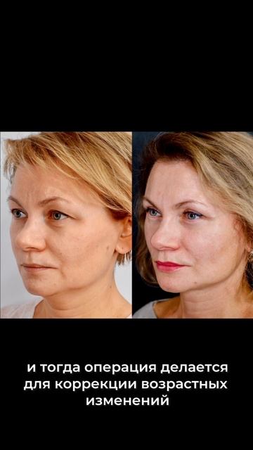 Блефаропластика не всегда является единственной эффективной операцией