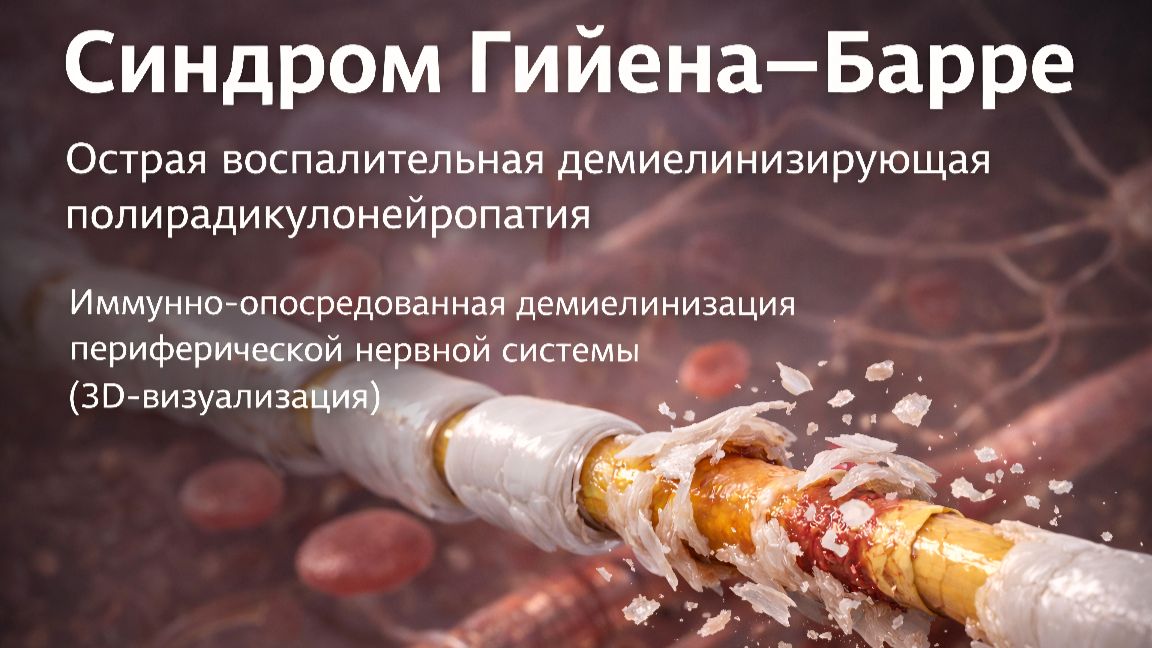 Синдром Гийена–Барре (ГБС)