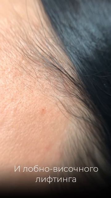 Швы после пластики верхних век и лобно-височного лифтинга
