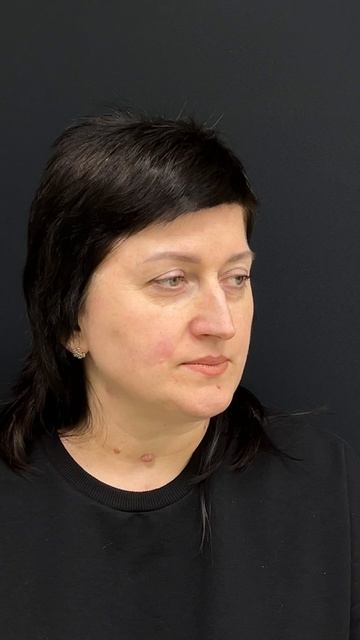 Ринопластика 6 месяцев после операции.