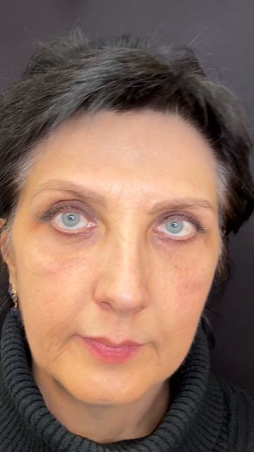 Блефаропластика