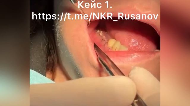 НКР 1.1.4 Осмотр через 2 недели после установки мембраны Zertan