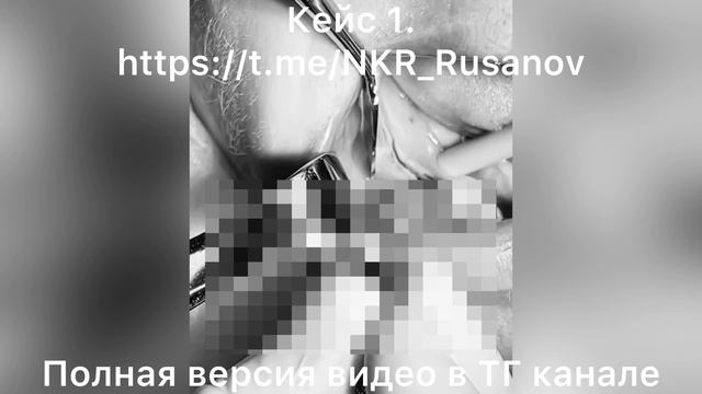 НКР 1.1.5 Снятие мембраны Zertan, установка имплантов.