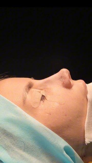 Результат ринопластики на операционном столе