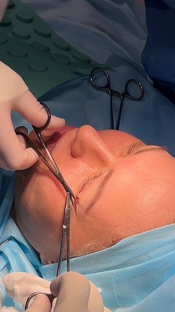 Новый открытый взгляд спустя 10 дней после пластики верхних век