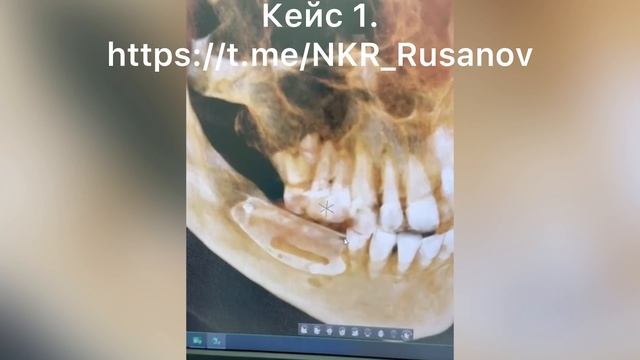 НКР 1.1.3 РГ контроль после операции