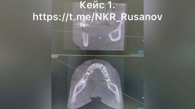 НКР 1.1.6 РГ контроль после имплантации