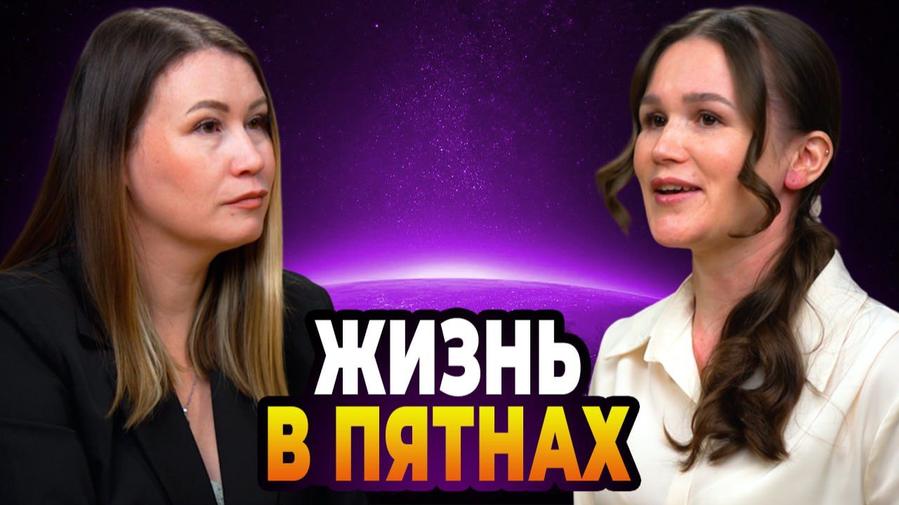 Витилиго: случайность или знак судьбы? Честная история без мифов.