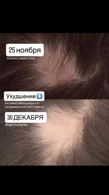 Начал расти пушок #алопеция#дети