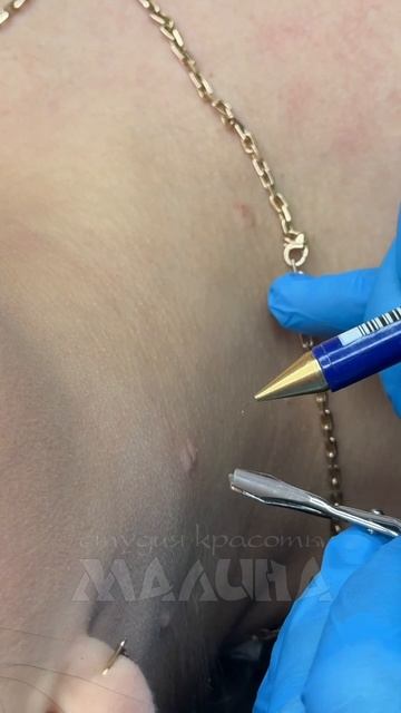 УДАЛЕНИЕ ПАПИЛЛОМЫ ВОЛГОГРАД