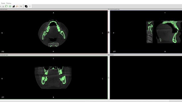Экспорт STL файлов из Dicom файла КТ для 3Д-печати