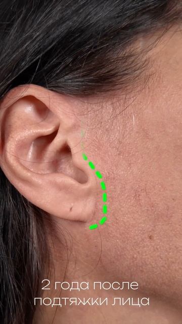 Прошло 2 года после подтяжки лица. Заметили бы рубцы без подсказки?