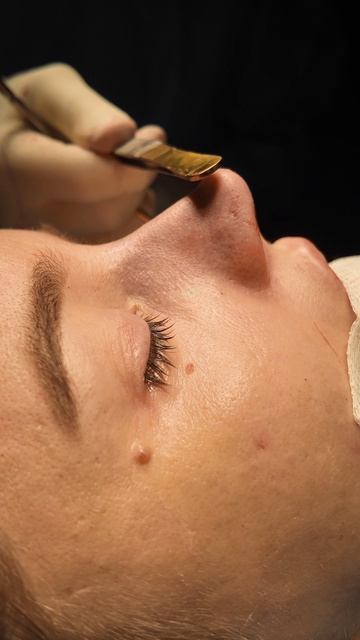 Выполнена #гибриднаяринопластика, сочетающая элементы структурной и сохраняющей.