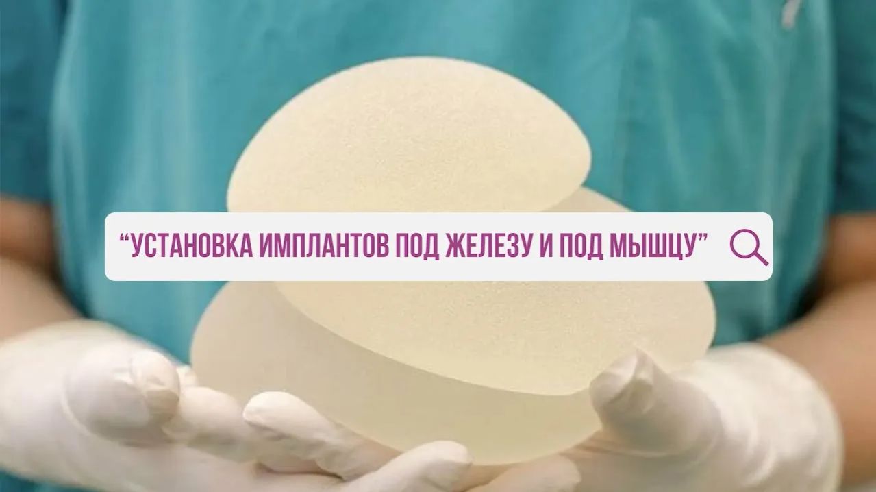 Установка имплантов под мышцу или под железу? какой вид фиксации выбрать?
