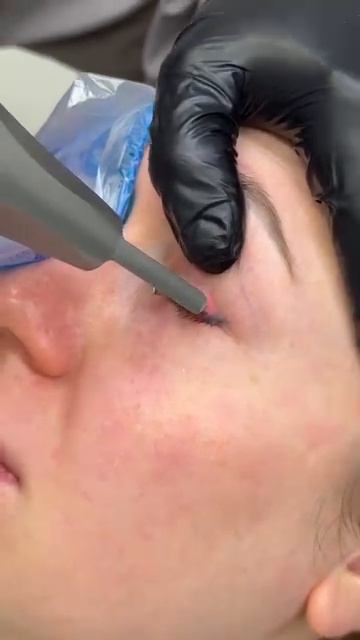 Удаление татуажа век за 7 секунд 💪