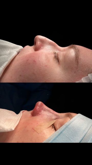 Ринопластика