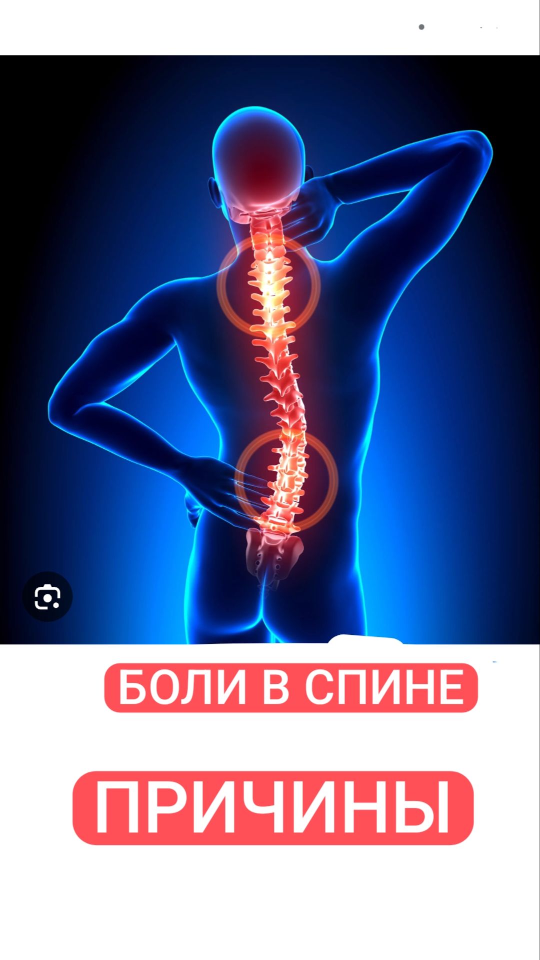 Боли в спине. Причины. Сакроилеит