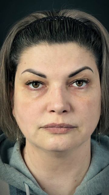 Ринопластика. 4 месяца после операции.