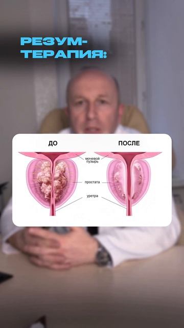 ЧЕМ ЛЕЧИТЬ АДЕНОМУ? | ГОПЛАЧЕВ АСЛАН АЛЕКСЕЕВИЧ