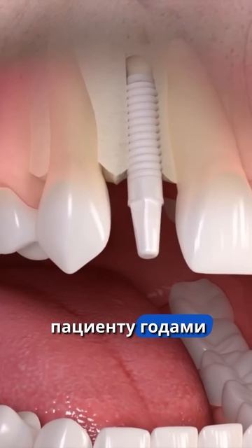 Опасна ли имплантация ? #dentist