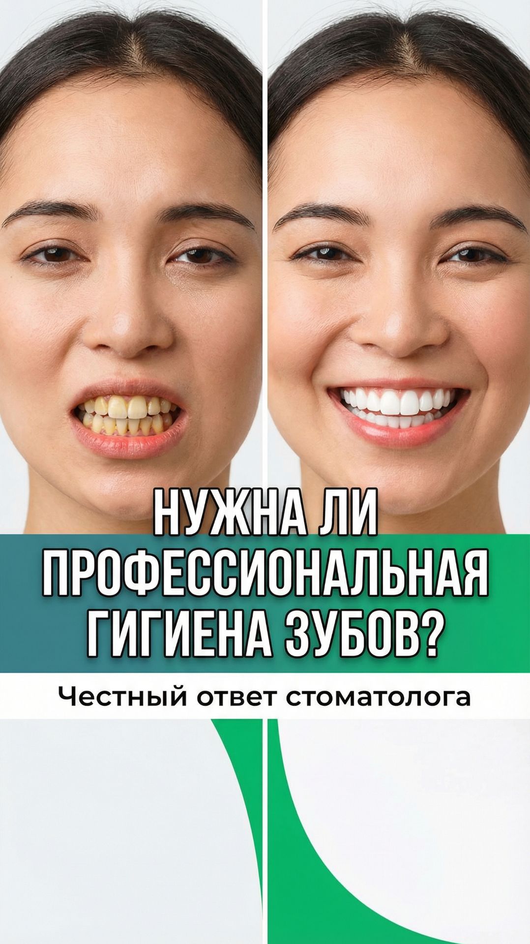 Нужна ли профессиональная гигиена зубов?  #стоматологиядоминанта #гигиенаполостирта  #зубы