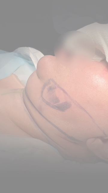 Результат на операционном столе после проведения #deepnecklift.