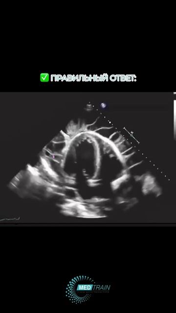 Что на эхограмме? 👀 Подсказка: сердце на эхокардиографии выглядит... немного «лохматым».