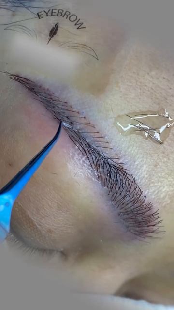 Экологическая пересадка волос AF — демонстрация запатентованной технологии